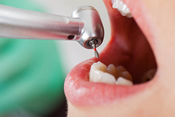 Best Emergency Dentist for Lost Fillings or Crowns in Alcoa, TN